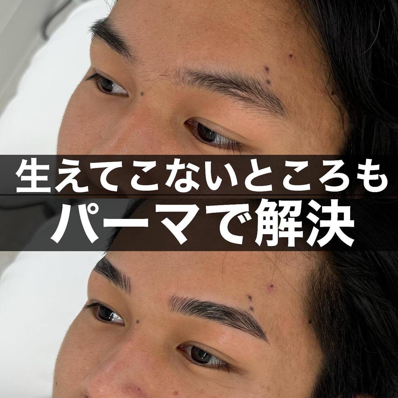施術後のアフターケア方法